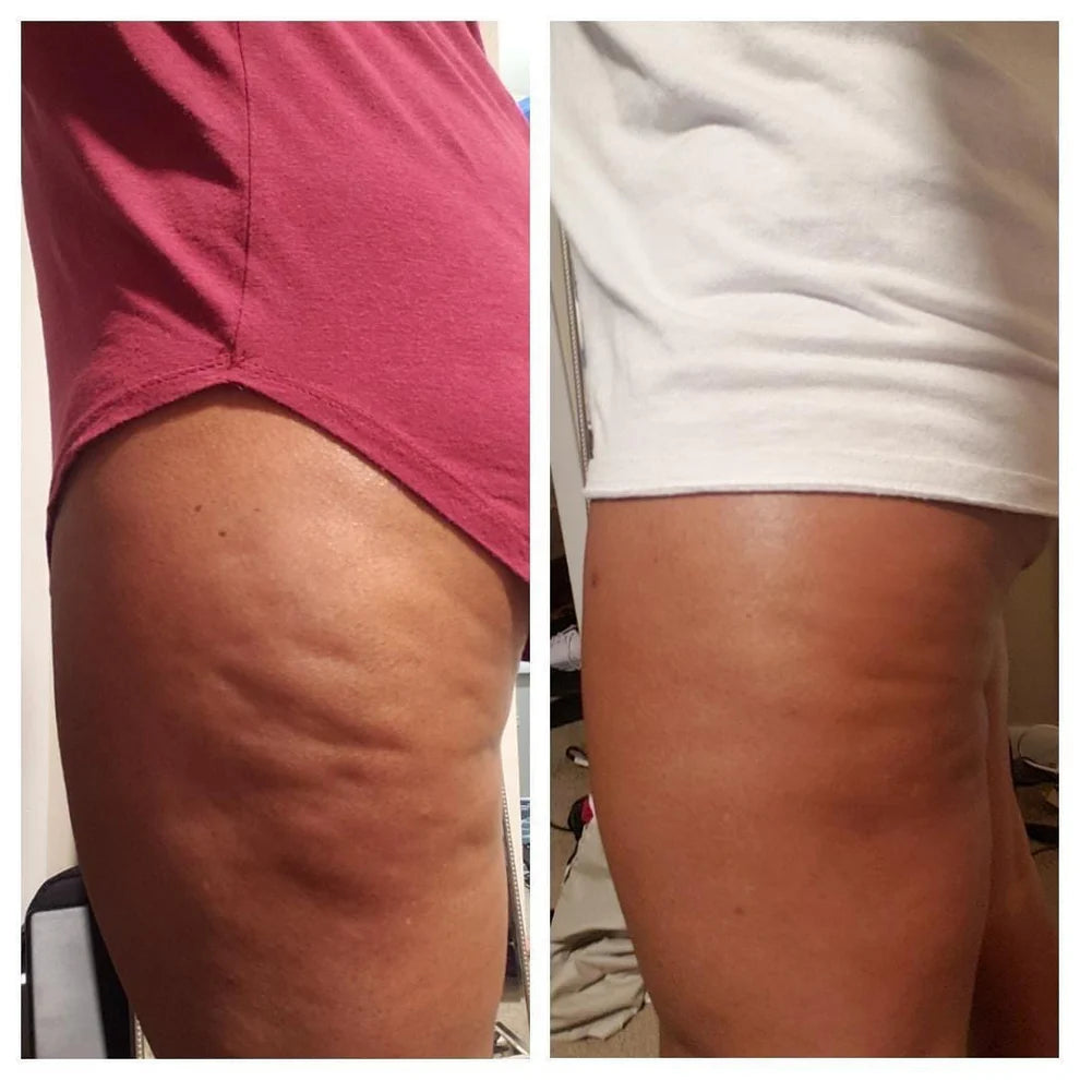 CeraLyn® Anti Cellulite Massage Oil